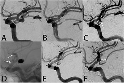 Stent-assisted coiling using the Neuroform Atlas stent for treatment of aneurysms that recur after coil embolization